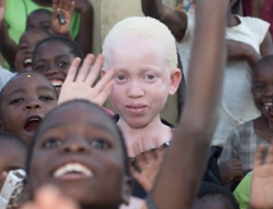 Ljudje z albinizmom v Malaviju imajo dostop do sončnih krem, vendar še vedno preganjani